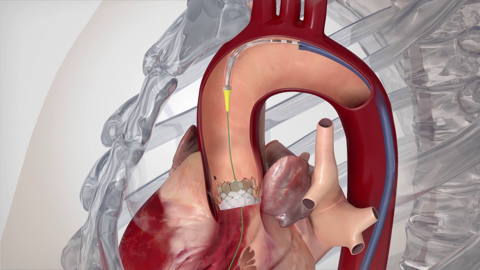 Aortic Valve Replacement Without Open Surgery: TAVI in Punjab
